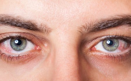 Understanding Dry Eye: Expert Treatment Insights from Oakville