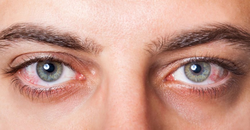 Understanding Dry Eye: Expert Treatment Insights from Oakville
