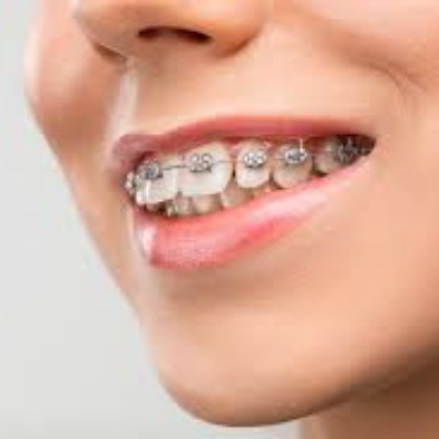 Say Hello to Straight Teeth – Discover the Power of Braces in Riyadh