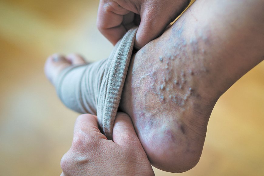 Get Rid of Varicose Veins with Top Treatments in Abu Dhabi