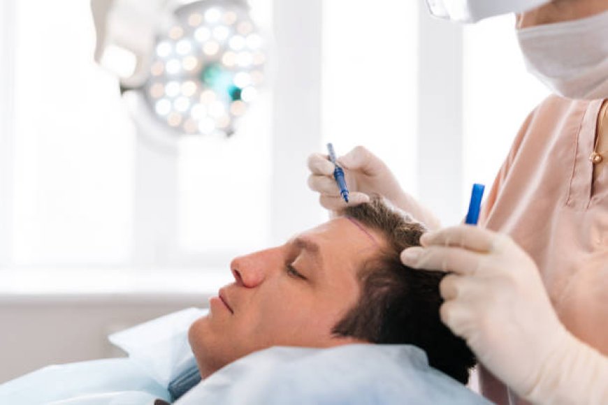 Celebrity Secrets: Are Riyadh’s Public Figures Fueling the Hair Transplant Boom?