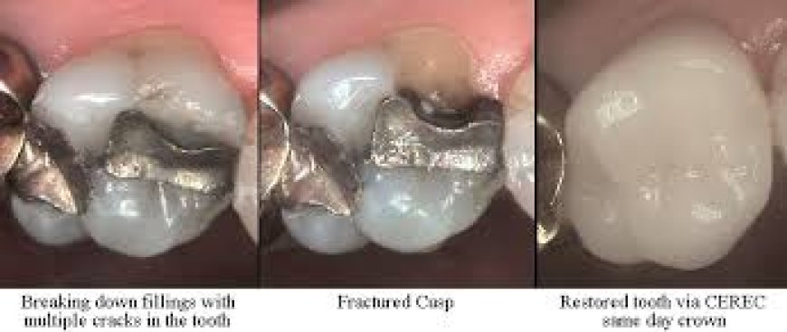 How Same Day Fillings Are Making Dental Visits More Convenient