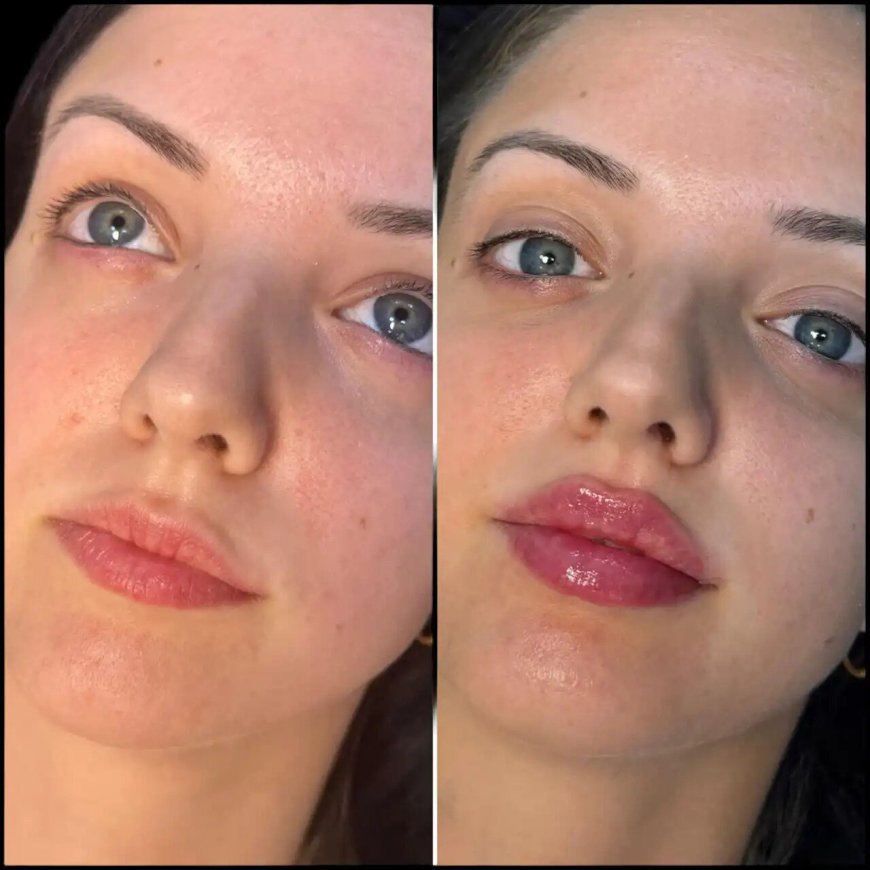 Non-Surgical Jawline Contouring with Fillers in Dubai