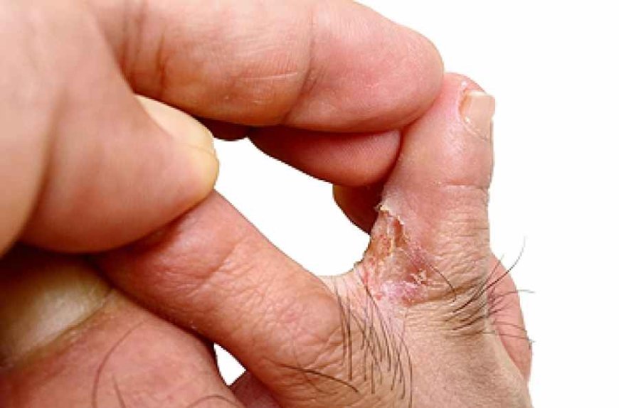 Secondary Infections: When Eczema or Athlete’s Foot Gets Worse