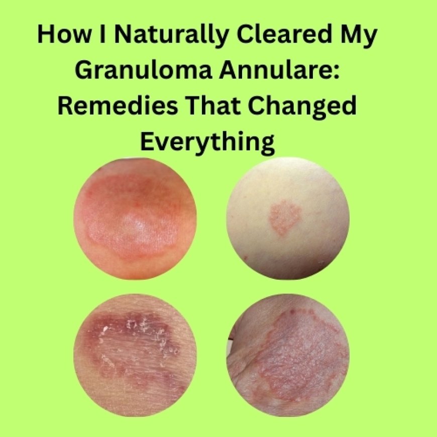 How I Naturally Cleared My Granuloma Annulare: Remedies That Changed Everything