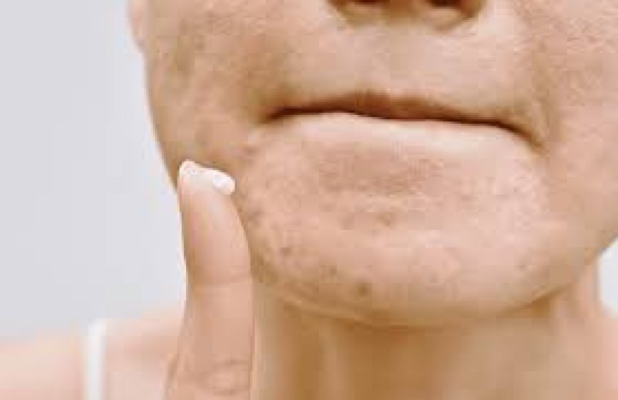 What Skincare Routine is Best for Preventing Hyperpigmentation in Asian Skin?