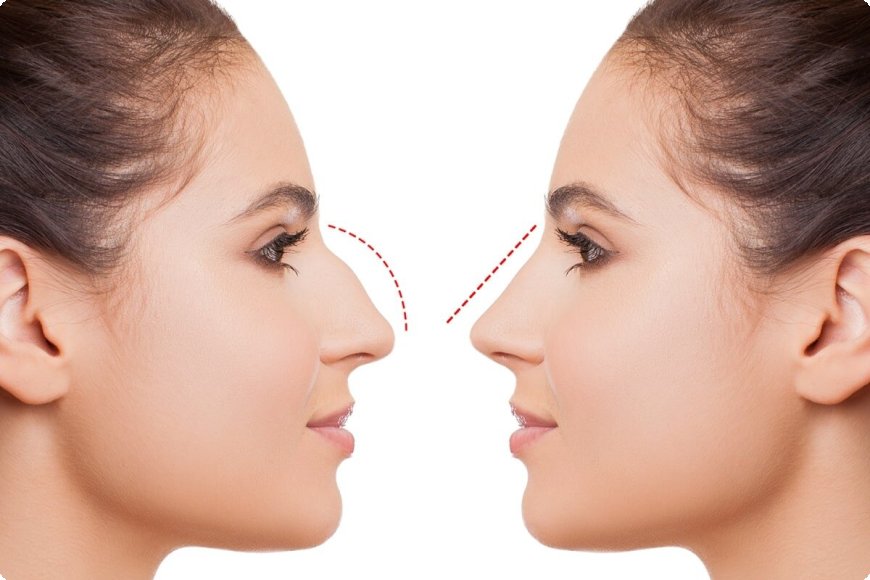 Safety and Accreditation: Ensuring Quality in Rhinoplasty in Islamabad