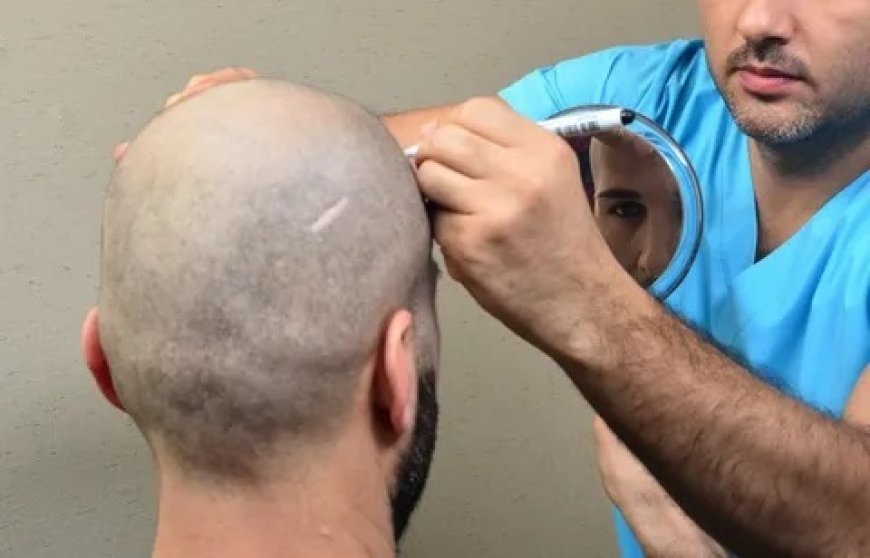 Transform Your Look with Expert Hair Transplant in Dubai