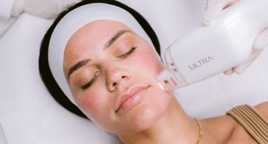 Spectra Laser Treatment: A Gentle Powerhouse for Clearer, Brighter Skin