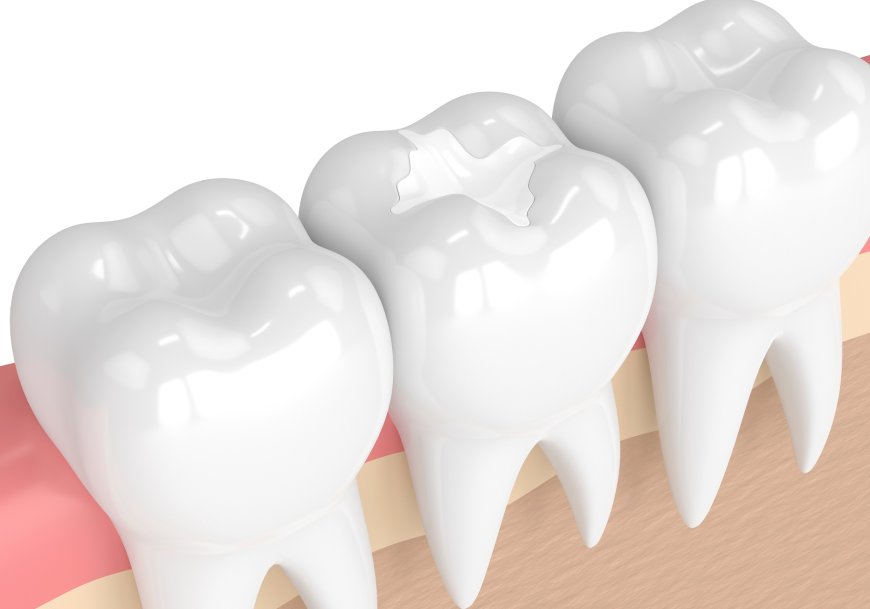 Fix Cavities Fast Best Tooth Fillings in Glasgow Montana