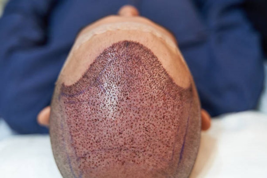 Hair Transplant in Riyadh: What to Expect Before and After