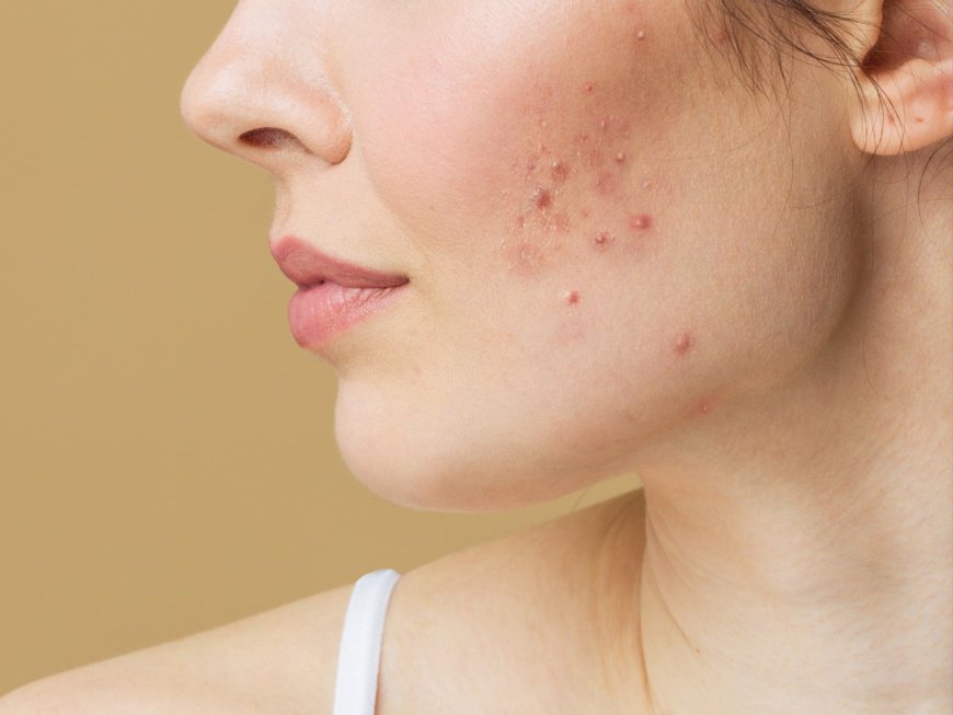 Acne Treatment for Women in Dubai
