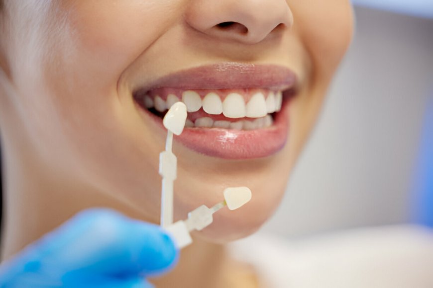 Transform Your Smile: Everything You Need to Know About Dental Veneers at Carolina Smiles Family Dentistry