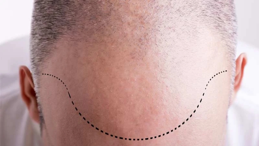 Natural Looking Hair Transplants In Dubai