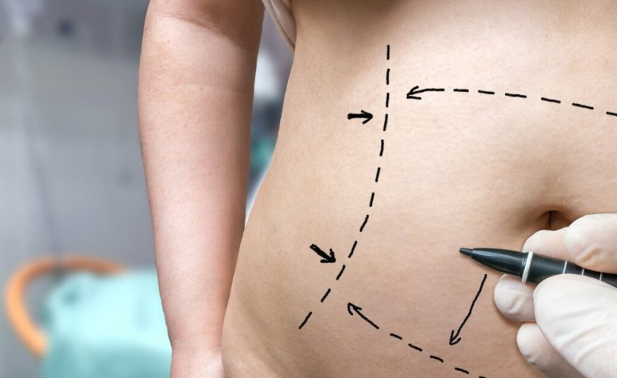 How Long Is Recovery From Tummy Tuck In Dubai?