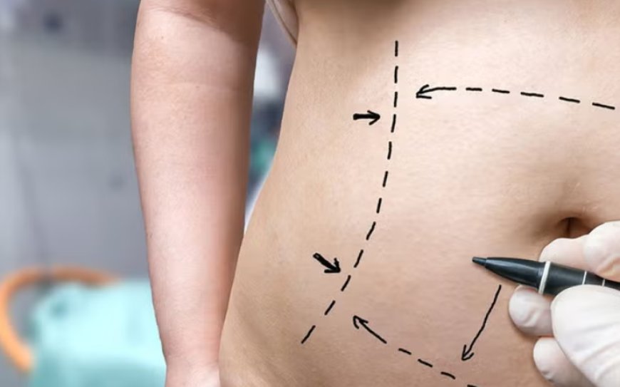 Maintaining Your Tummy Tuck Results: Diet and Exercise Tips