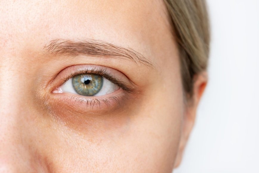 Under-Eye Fillers for Dark Circles Treatment in Dubai