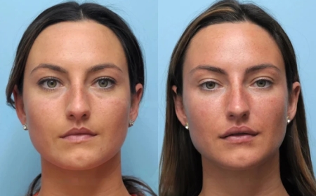 Why You Need the Best Plastic Surgeon in Dubai for Thread Lift
