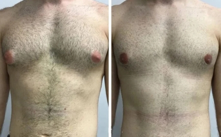 Top Clinics with the Best Gynecomastia Surgeons in Dubai