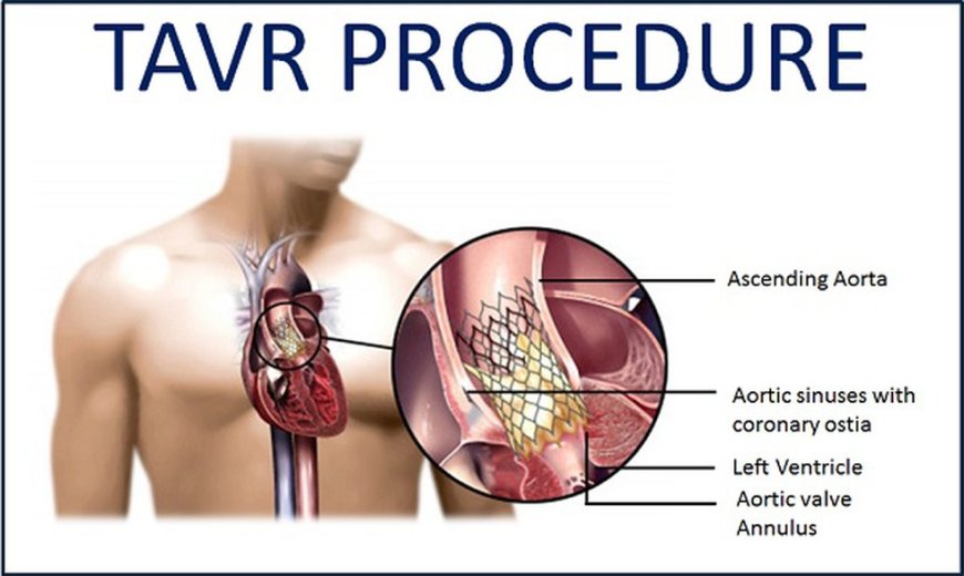TAVR Cost in India: Affordable and Advanced Heart Valve Replacement Solution