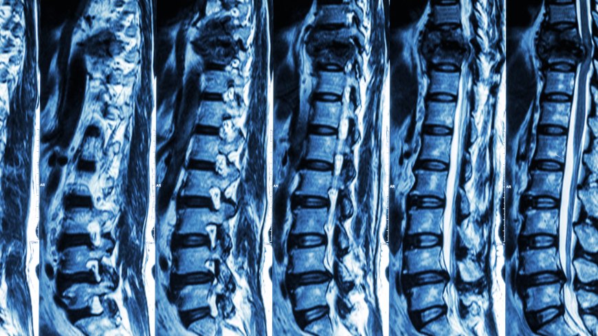 Asia-Pacific Spinal Fusion Market Size, Forecast 2025-2033: A Comprehensive Industry Analysis