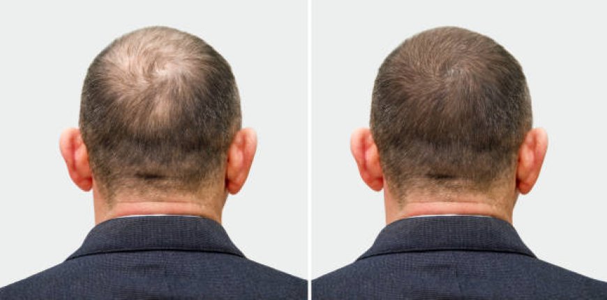 Discover the Best Hair Transplant in Riyadh