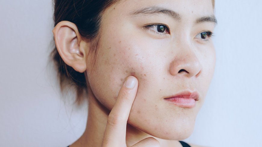 Finally, a Real Solution for Acne in Dubai