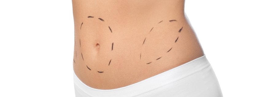 When Is The Best Age For Tummy Tuck In Dubai?