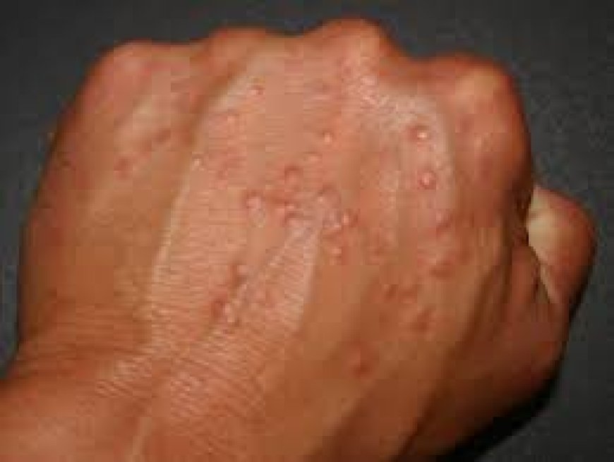 Granuloma Annulare Gone Naturally: The Top Home Remedies Revealed