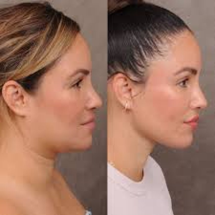 Neck Lift in Beverly Hills: Rewind the Signs of Aging with Expert Care