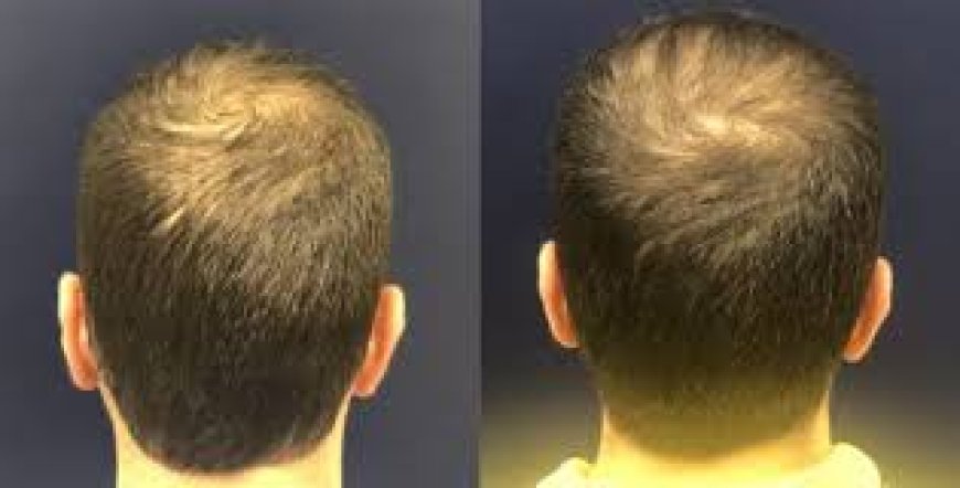 Why More People Are Choosing Non-Surgical Hair Restoration in Los Angeles