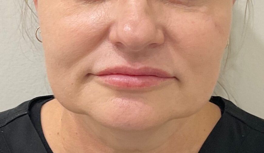 Can Belkyra Treatment help with jowls?