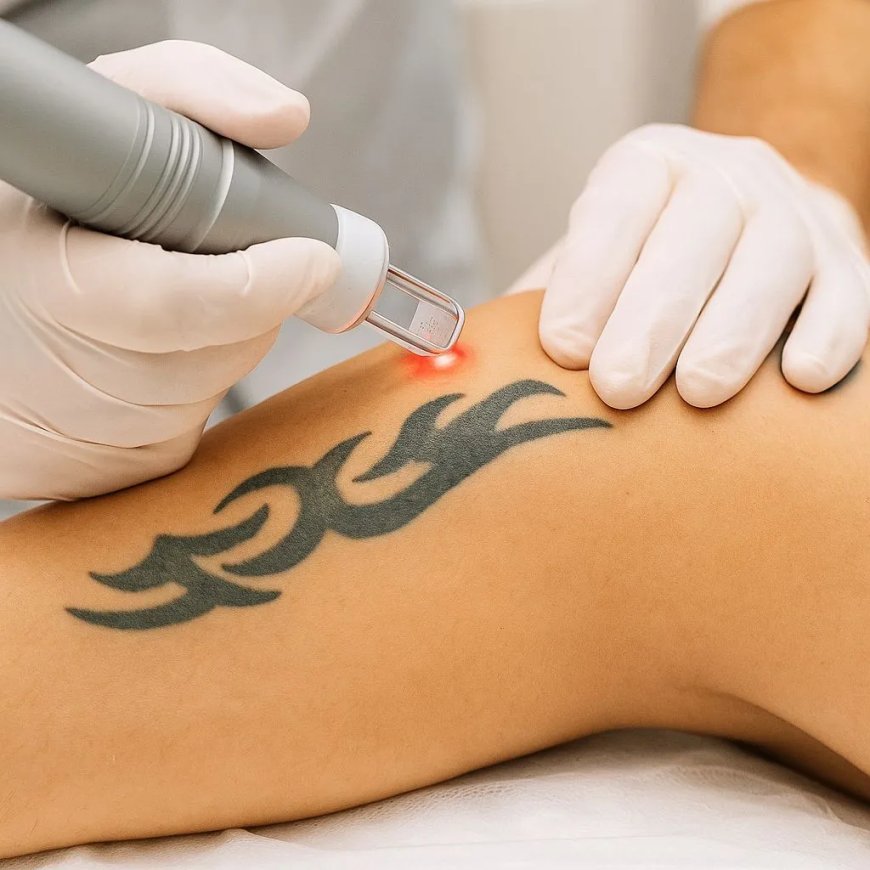 What are the latest Tattoo Removal trends?