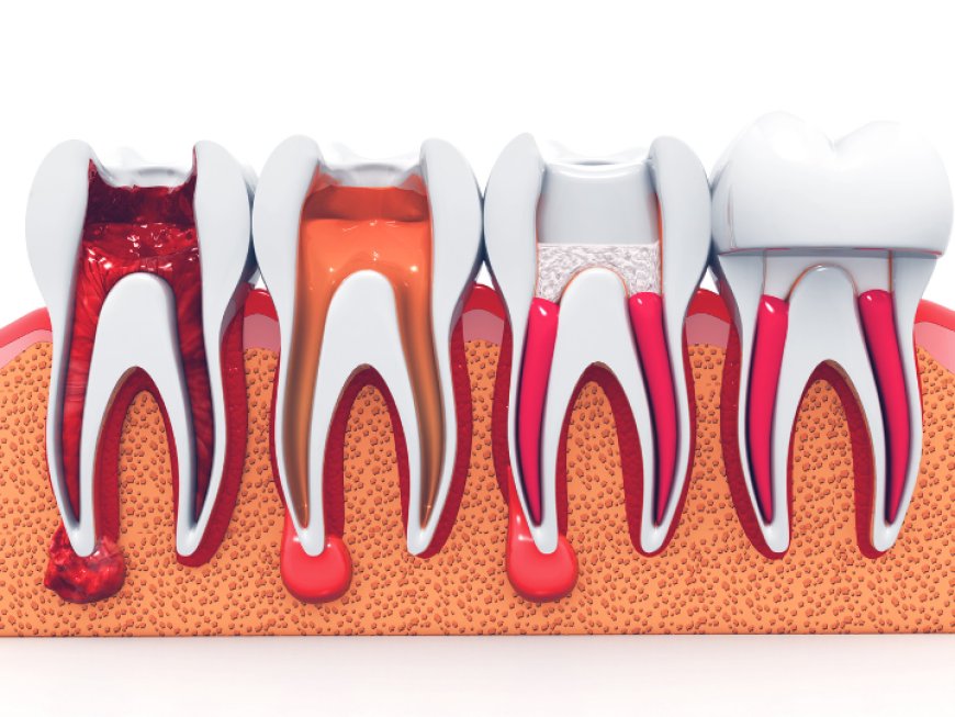 How Can You Tell If You Need a Root Canal or Just a Filling in Fairfax, VA?