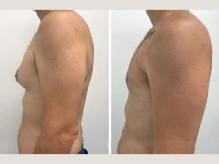 The Role of Follow-Up Care After Gynecomastia Surgery in dubai