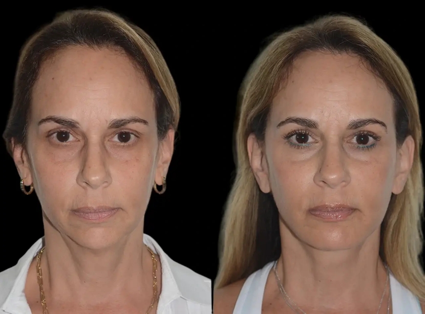Tips for Maintaining Your Chin Fillers Results from the Best Plastic Surgeons in Dubai