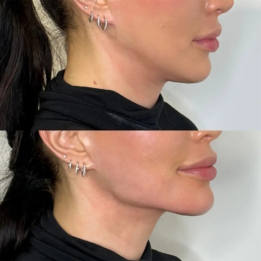 How Best Plastic Surgeons in Dubai Use Jawline Fillers for Facial Contouring