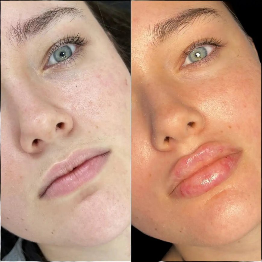 Best Plastic Surgeons in dubai Share Anti-Aging Fillers Secrets