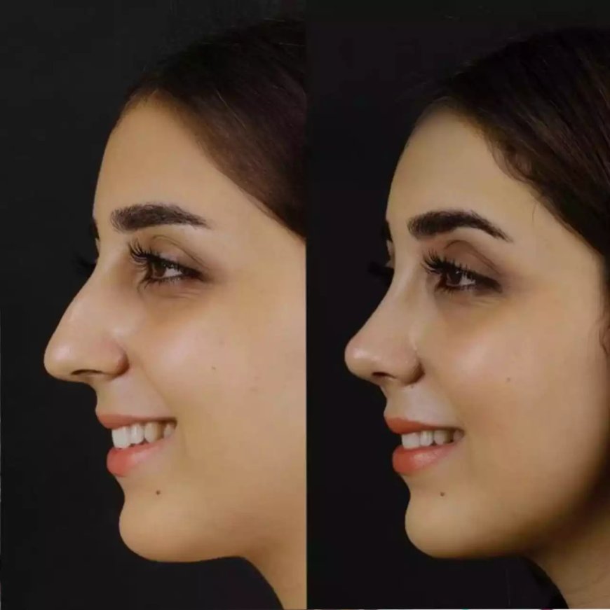 Why Patients Trust the Best Septoplasty Surgeon in Dubai