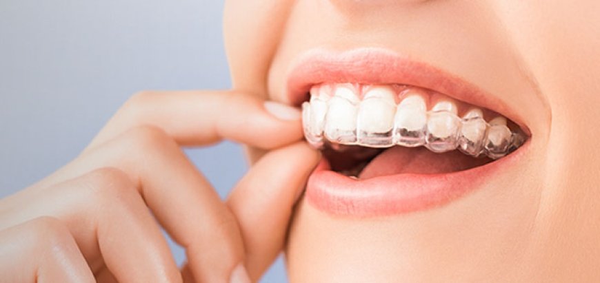 The Benefits of Invisalign for a Confident, Clear Smile