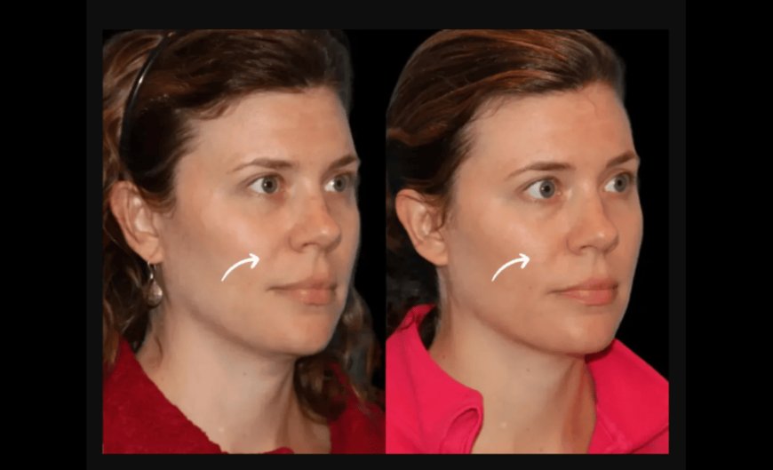 How Dubai's Best Plastic Surgeon is Revolutionizing Sculptra Fillers Treatments