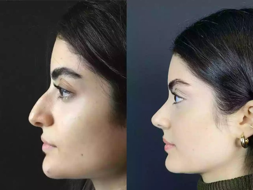 Healing & Harmony with the Best Rhinoplasty Surgeon in Dubai