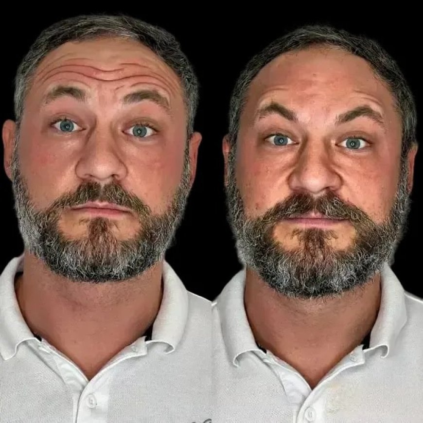 Launch Skin Transformation with Profhilo by the Best Plastic Surgeon in dubai