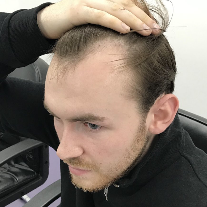 What is the Best Age for a Male Hair Transplant?
