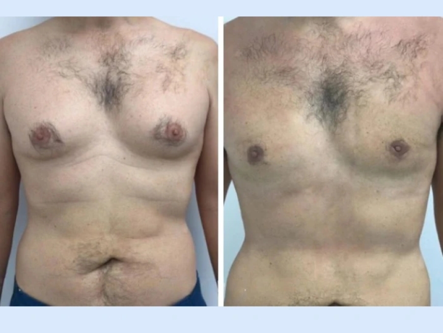 The Benefits of Choosing the Best Gynecomastia Surgeon in Dubai for a Safe Surgery