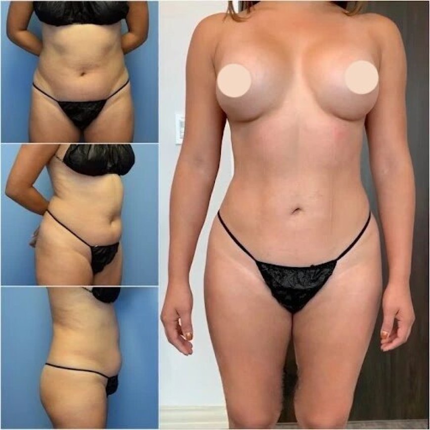 Choose the Best Body Contouring Surgeon in Dubai for a Sculpted Physique