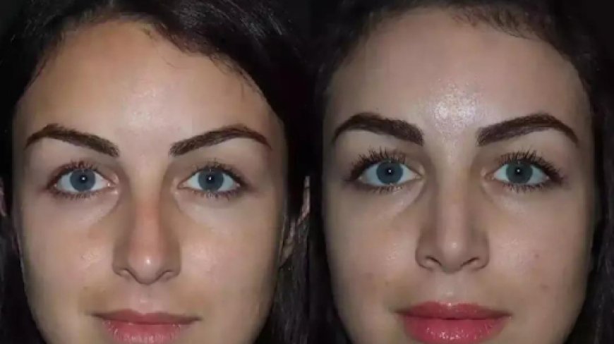 Best Rhinoplasty Surgeon in Dubai for Tip Refinement