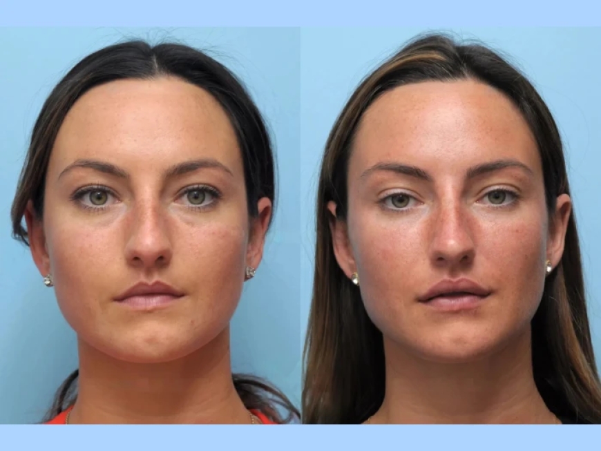 Why You Need the Best Plastic Surgeon in Dubai for Thread Lift