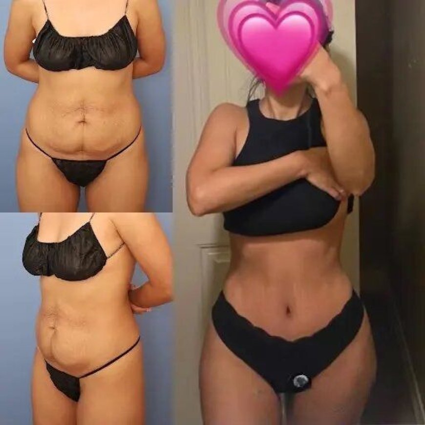 Finding the Best Tummy Tuck Surgeon in Dubai for Your Dream Abdomen