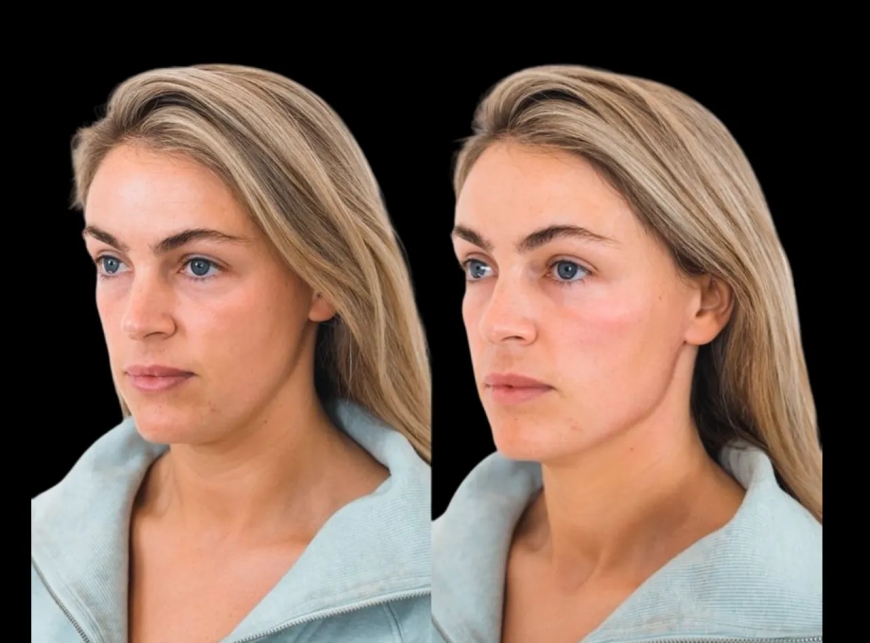 How to Determine if Cheek Fillers Treatment in Dubai is Right for You